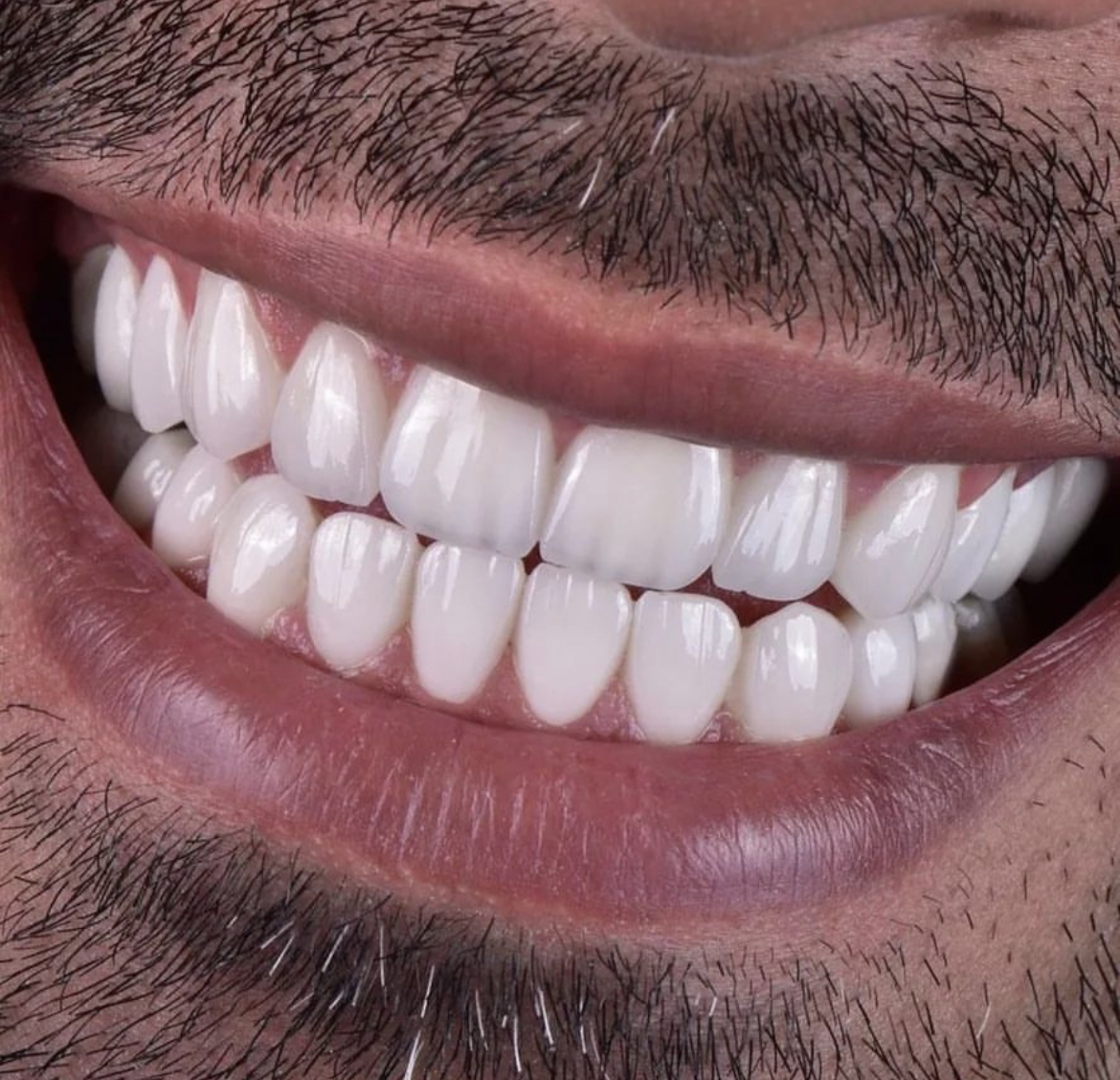 Real veneer result from Smile Designers Dental Center