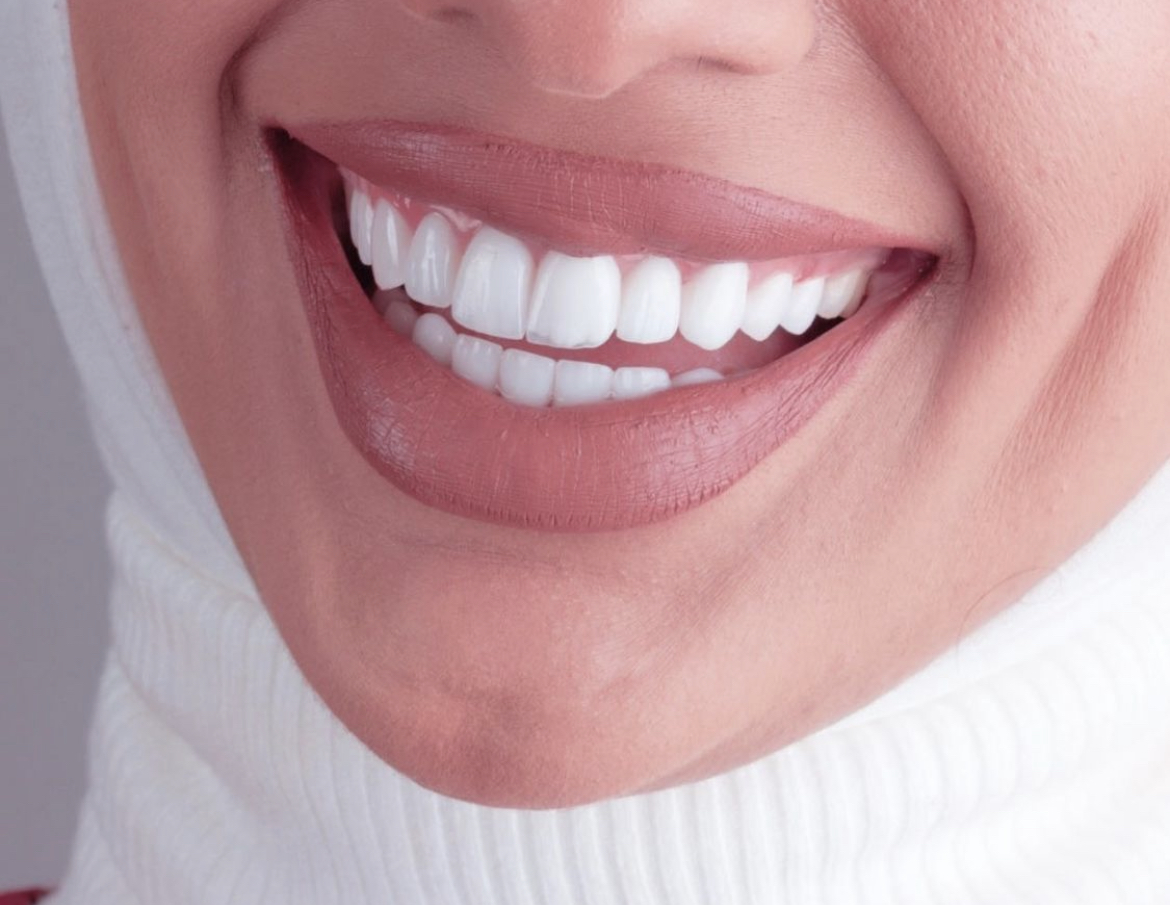 Radiant natural smile after cosmetic treatment at Smile Designers