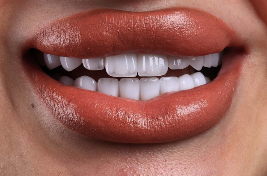 Bright even smile result after cosmetic dental treatment