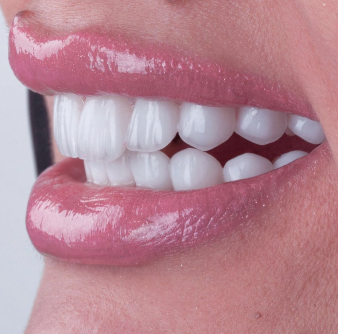 Perfectly white aligned smile after veneer treatment